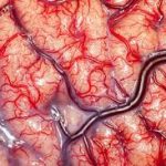 گرفتگی رگ های مغزی و ارتباط آن با سکته مغزی